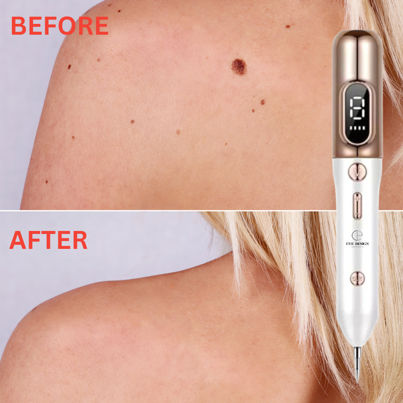 Moles, Freckles, Skin Tags and Spots Remover
