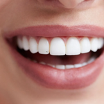 Tooth Gem Glue - Dental Adhesives - Dental Essentials - Dentluxe